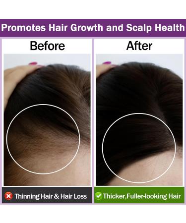 Organic Rosemary Oil for Hair Growth - 100% Pure Essential Oil with Hair Roller | Non-Greasy Hair Growth Serum for Women & Men - Eyebrow, Eyelash and Scalp Care - Buy Online on GoSupps.com