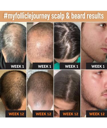 Biotin Hair Growth Shampoo - Vegan DHT Blocker Thickening Treatment for Men & Women - Caffeine Saw Palmetto & Argan Oil for Thinning Hair - Buy Online on GoSupps.com