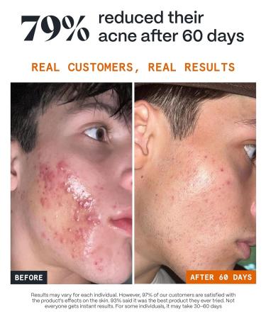 Norse Organics | The Complete System For Pimples | 3 Step System with Day Night Balms & Face Scrub | Arctic Herbs & Beeswax | Natural Face Care for Teens Adults Men Women | Complete Kit - Buy Online on GoSupps.com