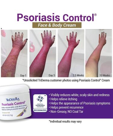 TriDerma Psoriasis Control Cream 4 oz - Fast-Acting Relief for Psoriasis Symptoms - Buy Online on GoSupps.com