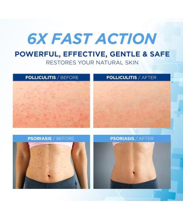Folliculitis Treatment Cream 100g - Effective Relief for Scalp Face & Body | International Shipping - Buy Online on GoSupps.com