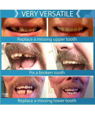 Instant Smile Tooth Replacement Kit - Complete Your Smile in Minutes - Patented Solution - Buy Online on GoSupps.com