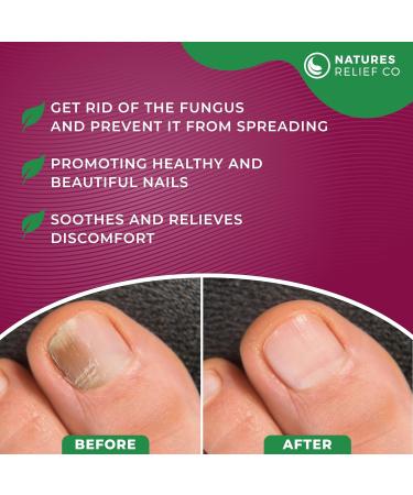 100ml All-Natural Anti Fungal Toenail Spray for Severe Toenail Fungus Treatment - Buy Online on GoSupps.com