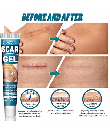 Scar Gel 20 G Effective in Treating Scars C-Section Scars Stretch Marks Acne Surgery Burns Effective On Old and New Scars - Buy Online on GoSupps.com