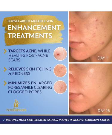 2oz Niacinamide Serum for Face 10% with Zinc & Vitamin B3 - Acne Treatment, Pore Minimizer & Dark Spot Remover - Buy Online on GoSupps.com