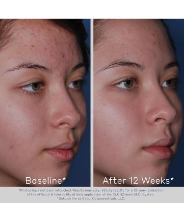 Obagi CLENZIderm M.D. Acne Treatment System | 3-Step 2% Salicylic Acid & 5% Benzoyl Peroxide | International Shipping - Buy Online on GoSupps.com