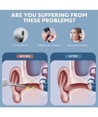 XLife Earwax Remover Tool with 1296P HD Camera and 6 LED Lights - Wireless Ear Cleaner for iPhone Android - IP67 Waterproof Otoscope Ear Wax Removal Kit - Buy Online on GoSupps.com