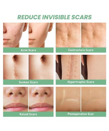 Mebak Clear Silicone Scar Gel Tape Roll (1.6 x 60) - Acne & C-Section Scar Removal Treatment - Reusable Transparent Strips for Keloid Surgery - Scars Treatment Sheets - Buy Online on GoSupps.com