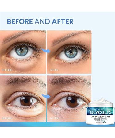 Buy Glycolic Acid Eye Cream 30g - Anti Wrinkle Hydrating Reduces Dark Circles & Puffiness - Buy Online on GoSupps.com