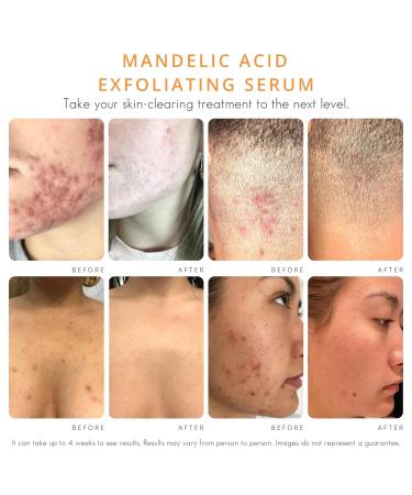 Face & Body Clearing Serum Level 1- for acne folliculitis aging skin ingrown hairs dark spots - face chest butt back thighs arms - mandelic acid - 1 fl oz - Buy Online on GoSupps.com