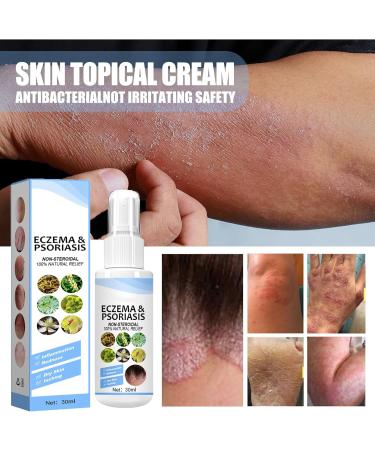 Melllop Brume de soulagement du psoriasis base de plantes brume de soulagement du psoriasis base de plantes hydrate la peau d licate de peau 1 Pi ce. - Buy Online on GoSupps.com