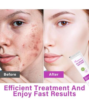 Azelaic Acid Serum Cream 12% Azelaic Acid Cream Redness Relief Face Balance Excess Sebum 20ml - Buy Online on GoSupps.com