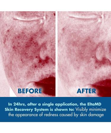 EltaMD Skin Recovery System: Gentle Essence Toner, Serum, Light Moisturizer (3-Piece Set) - Buy Online on GoSupps.com
