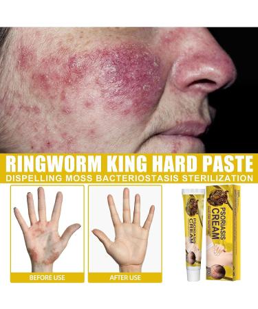 Doxenem Eczema & Psoriasis Cream - Control Reoccurrence, Tinea Versicolor Treatment, Dark Spots Relief for Adults - Buy Online on GoSupps.com