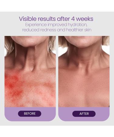 KOKOBAL PureCalm Anti-Itch Serum - Organic Skin Relief for Irritation Inflammation & Dryness | Hydrating Serum for Acne Sunburn & Sensitive Skin | 4 Oz - Buy Online on GoSupps.com