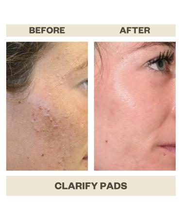 AziMD Skincare Clarify Pads for Face & Body Acne | 2% Salicylic & Glycolic Acid - International Shipping Available - Buy Online on GoSupps.com
