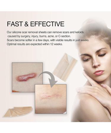 Krucasano Silicone Scar Removal Sheets - 4 Month Supply for Keloid, C-Section, Post-Surgery & Acne Scars - 1.57 x 5.9 - 8 Sheets - Buy Online on GoSupps.com