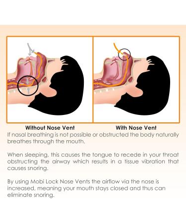 Buy Nose Vent Sinus Relief - Pack of 12 Reusable Snoring Devices for Peaceful Sleep | Mobi Lock - Various Sizes & Types - Buy Online on GoSupps.com