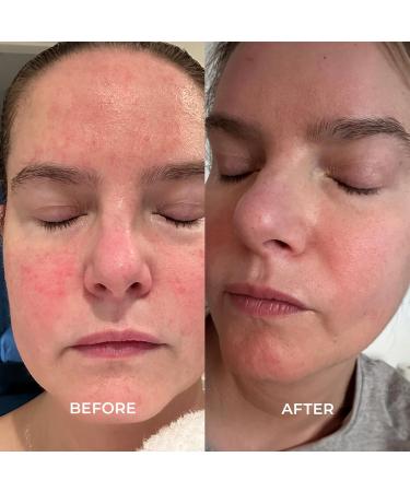 Miami Beach Bum Hydrating Face Rescue Cream | Hyaluronic Acid Squalane Vitamins A & C | Non-Greasy Fragrance-Free Ideal for Sensitive & Acne-Prone Skin - Buy Online on GoSupps.com