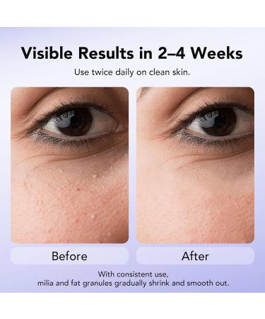 DERMFREE MILIA REMOVER 30 mL Milia Remover Treatment Milia Spot Treatment with Salicylic Acid Milia Acne Serum Clearing Skin Essence - Buy Online on GoSupps.com