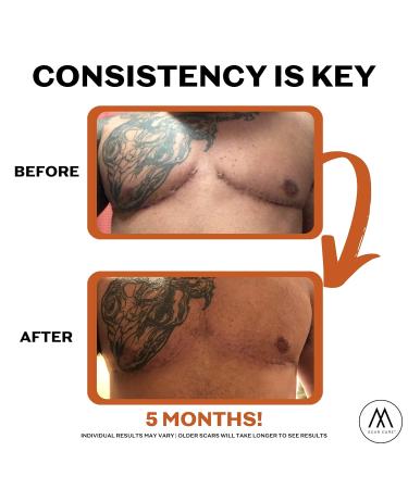 Motivo Scar Care Bundle - Scar Tape & Cream (15ml) | Water & Sweat Resistant, Ideal for Surgical, C-Section, Trauma & Acne Scars | Suitable for All Skin Types | Tan - Buy Online on GoSupps.com