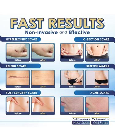 Silicone Scar Sheets 1.6 x 60-1.5M - Keloid & Burn Therapy Gel Tape for Scar Removal - Buy Online on GoSupps.com