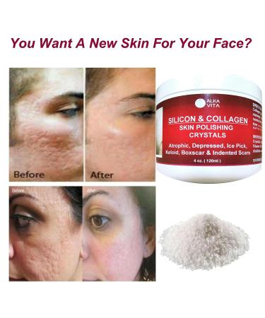Clear Alka Vita Acne Scars Gel - Silicon & Collagen Crystals for Atrophic & Keloid Scars - 4.0 Fl Oz - Buy Online on GoSupps.com
