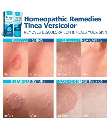 Roycederm Antifungal Cream for Tinea Versicolor & Athlete's Foot Treatment 2 oz - Fast Healing Anti Fungal Skin Cream - Buy Online on GoSupps.com