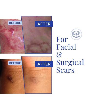 Rejuvaskin Scar Heal Kit - Small to Medium Scar Treatment - Soften, Flatten, and Reduce Scars - Physician Recommended - Buy Online on GoSupps.com