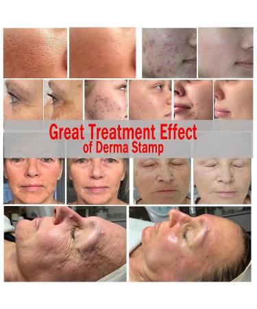 CLETINA Adjustable Microneedling Derma Stemp Pen - 140 Titanium 0.25mm Pins for Face, Body, Skin, Hair & Beard Growth - Buy Online on GoSupps.com