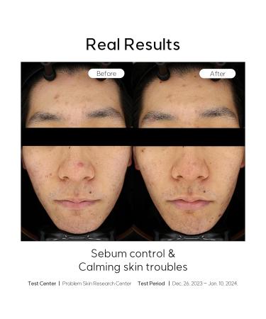 Teatree Calming Toner Pads | Vegan Acne Treatment | 120 Soothing Face Gauze Pads for Sensitive Skin - Buy Online on GoSupps.com