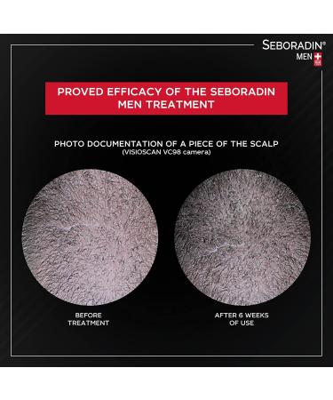 Seboradin Ampoules FORTE for Men Anti-hair loss Intensive Baldness Treatment 14 Ampoules of 5.5 ml - Buy Online on GoSupps.com