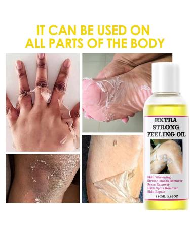 Yellow Peeling Oil - Extra Strength Chemical Peel for Dark Skin & All Skin Types | Exfoliating Solution 1 Bottle - Buy Online on GoSupps.com