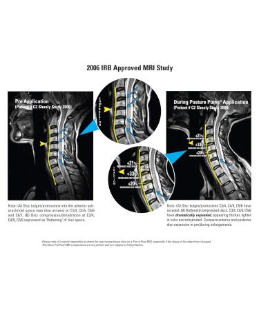 Posture Pump 1400-DX Cervical Neck Device - Dual Air Cell Pain Relief for Neck & Upper Back - Lightweight Easy to Use - Buy Online on GoSupps.com
