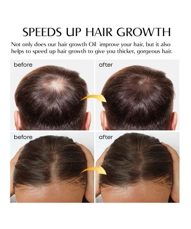 Ginger Hair Growth Serum | Prevent Hair Loss, Promote Thicker & Longer Hair | 1.7 Oz Bottle - Buy Online on GoSupps.com