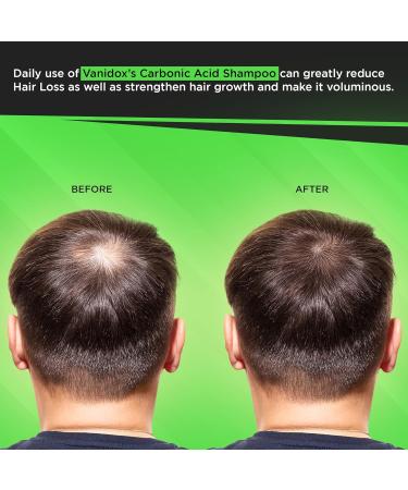 Carbonic Acid Shampoo for Men and Women with DHT Blockers - Made in USA - Stimulates Hair Growth, Scalp Exfoliator, Sulfate Free Shampoo with Biotin and Tea Tree Oil (16 Fl Oz) - Buy Online on GoSupps.com