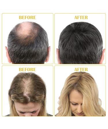 5% Minoxidil Hair Growth Serum Kit - Regrow Hair Thinning Treatment with Biotin - 2.02 Fl oz 1 Month Supply | International Shipping Available - Buy Online on GoSupps.com