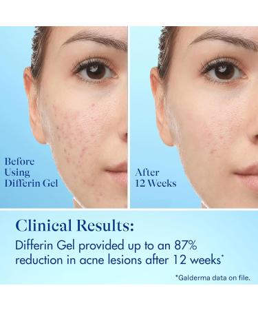 Differin Acne Fighter Pack Differin Gel Retinoid Acne Treatment For Face with 0.1% Adapalene 15g Tube + Salicylic Acid Pimple Patches 36 Count Designed for Pimple and Acne-Prone Skin - Buy Online on GoSupps.com