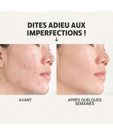  O l na Moisturizing face cream with salicylic acid. Treatment for dark spots blackheads and acne scars. 50 ml - Buy Online on GoSupps.com