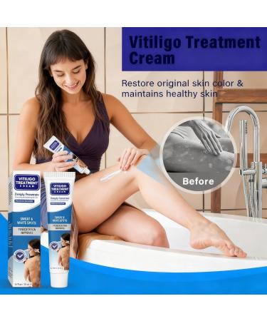 Clever sprouts Natural Vitiligo Treatment Cream - Gentle on Sensitive Skin 0.68 fl oz / 20ml Blue and White - Buy Online on GoSupps.com
