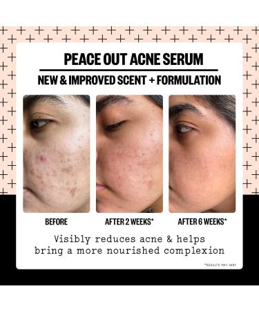 Peace Out Skincare Acne Serum - 2% Salicylic Acid for Clear Skin | Daily Multi-Benefit Face Serum | International Shipping Available - Buy Online on GoSupps.com