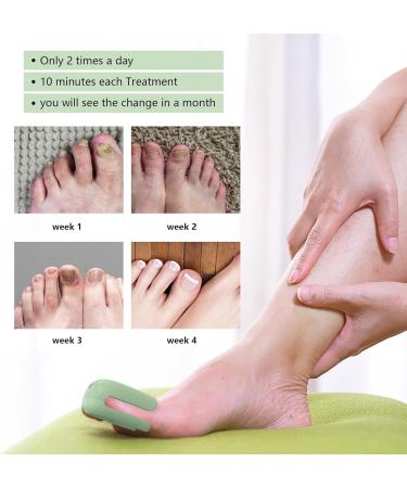 Nail Fungus Treatment Light Therapy Fungus Highly Effective Cleaning Device Rechargeable Fungus Treatment for Fingernails and Toenails Home Use (green) - Buy Online on GoSupps.com