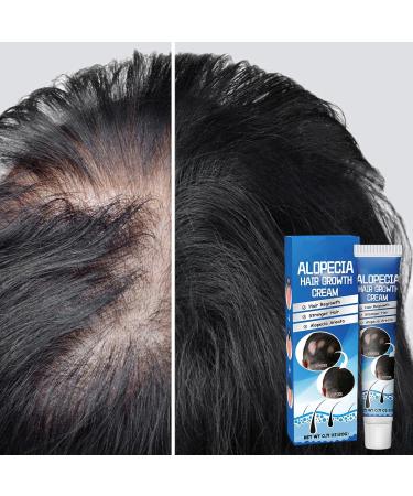  G n rique Baldness Cream - 20g Hair Growth Oil for Fast-Acting Effective Use Anti-Alopecia with High Hairline Solution Hairless Baldhead Hair Development Moisturizer for Men Women Thinning - Buy Online on GoSupps.com