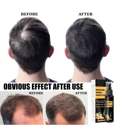 Ginger Germinal Oil Ginger Hair Growth Serum Ginger Essential Oil Stop Hair Loss Hair Thinning Treatment Hair Growth Oil for Women & Men 30ML (1pcs) - Buy Online on GoSupps.com