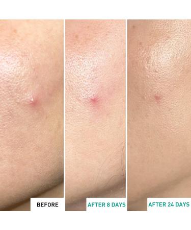 Erborian - Centella Acne Care - Soothing Moisturising Fluid 1% Bakuchiol/Patch Pimple Effect 10% PHA - Acne & Blemish Treatment - Korean Cosmetics SOS Patch - Buy Online on GoSupps.com