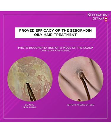 Seboradin Shampoo for Greasy Hair & Dandruff - 200ml | Anti-Hair Loss for Psoriasis & Eczema - Buy Online on GoSupps.com