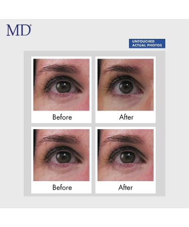 MD Ultimate Eye Cream - Reduce Dark Circles, Puffiness, and Wrinkles | Enriched with Collagen, Peptides, and Shea Butter for Firmness and Moisturization - Buy Online on GoSupps.com