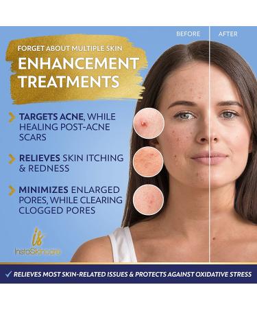 2oz Niacinamide Serum for Face 10% with Zinc & Vitamin B3 - Acne Treatment, Pore Minimizer & Dark Spot Remover - Buy Online on GoSupps.com