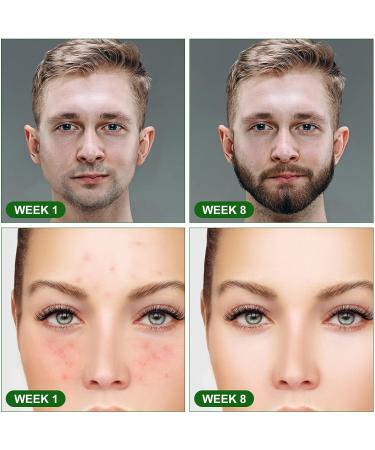 URAQT 2.5mm Derma Roller for Beard Growth and Facial Skin Care - 540 Titanium Micro Needles for Men and Women - Stimulate Hair Growth and Scar Removal - Buy Online on GoSupps.com