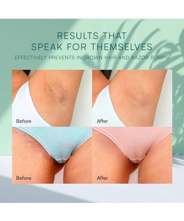 Intimate Ingrown Hair Treatment Kit - Bikini Bump Blaster & Razor Bump Solution - Buy Online on GoSupps.com